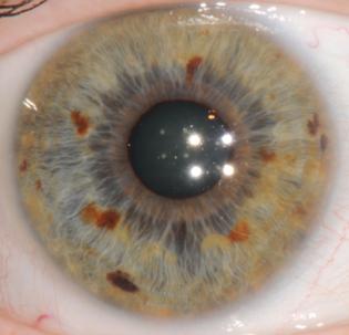 corso di iridologia a bologna immagine occhio 4
